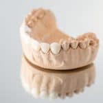 expat-dental-porcelain-veneers