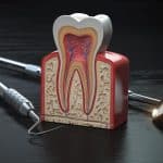 expat-dental-root-canal-therapy