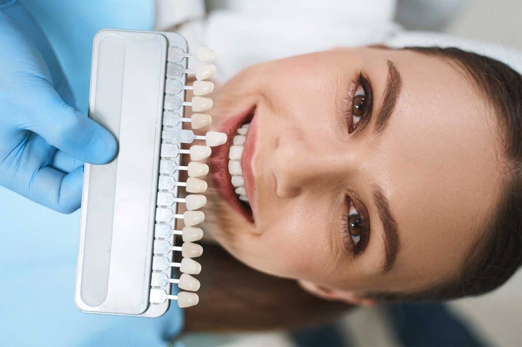 veneers