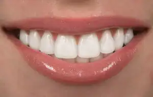 Dental Veneers vs. Smile Makeover in Singapore
